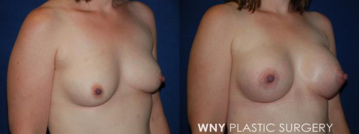 Before & After Breast Augmentation Case 210 Right Oblique View in Buffalo, NY