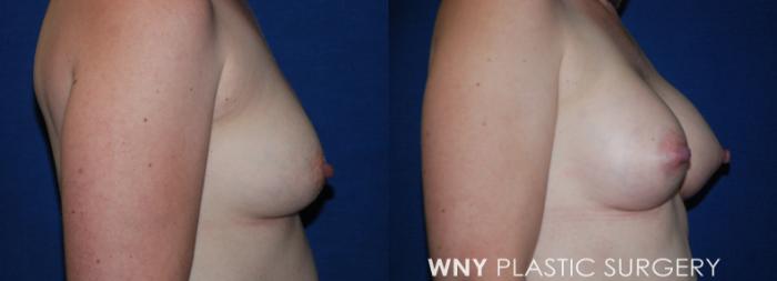 Before & After Breast Augmentation Case 210 Right Side View in Buffalo, NY