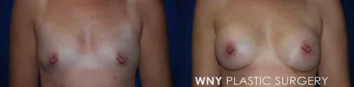Before & After Breast Augmentation Case 214 Front View in Buffalo, NY