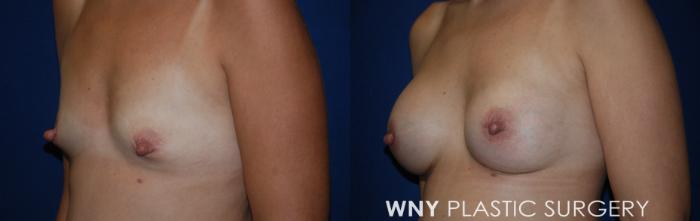 Before & After Breast Augmentation Case 214 Left Oblique View in Buffalo, NY