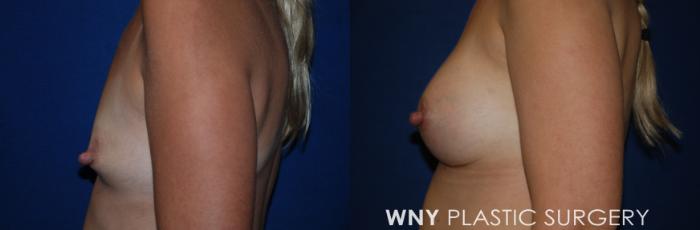 Before & After Breast Augmentation Case 214 Left Side View in Buffalo, NY