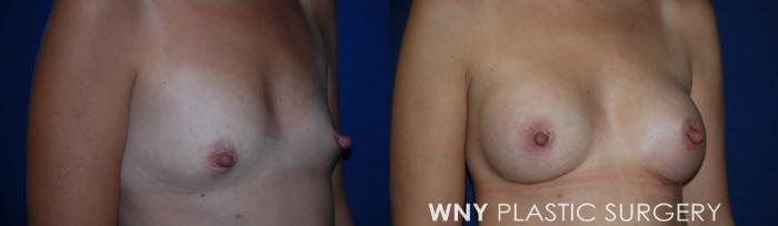 Before & After Breast Augmentation Case 214 Right Oblique View in Buffalo, NY