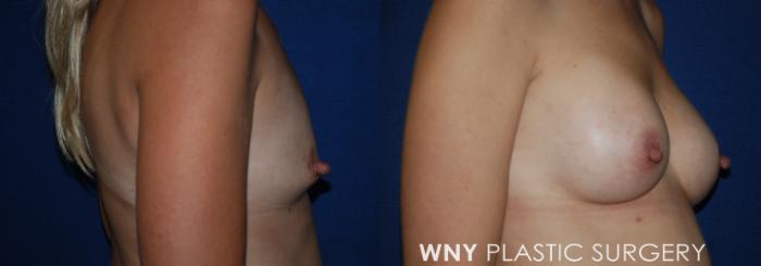 Before & After Breast Augmentation Case 214 Right Side View in Buffalo, NY