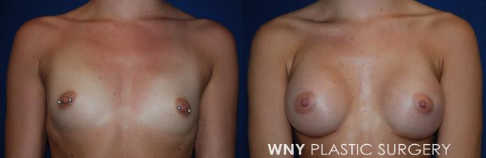 Before & After Breast Augmentation Case 219 Front View in Williamsville, NY