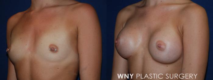 Before & After Breast Augmentation Case 219 Left Oblique View in Williamsville, NY