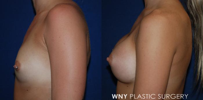 Before & After Breast Augmentation Case 219 Left Side View in Williamsville, NY