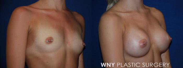Before & After Breast Augmentation Case 219 Right Oblique View in Williamsville, NY