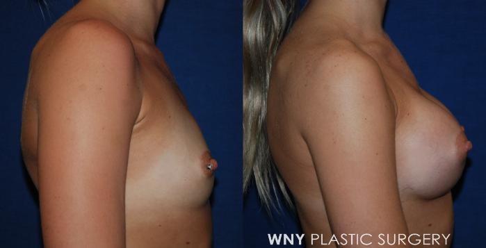 Before & After Breast Augmentation Case 219 Right Side View in Williamsville, NY