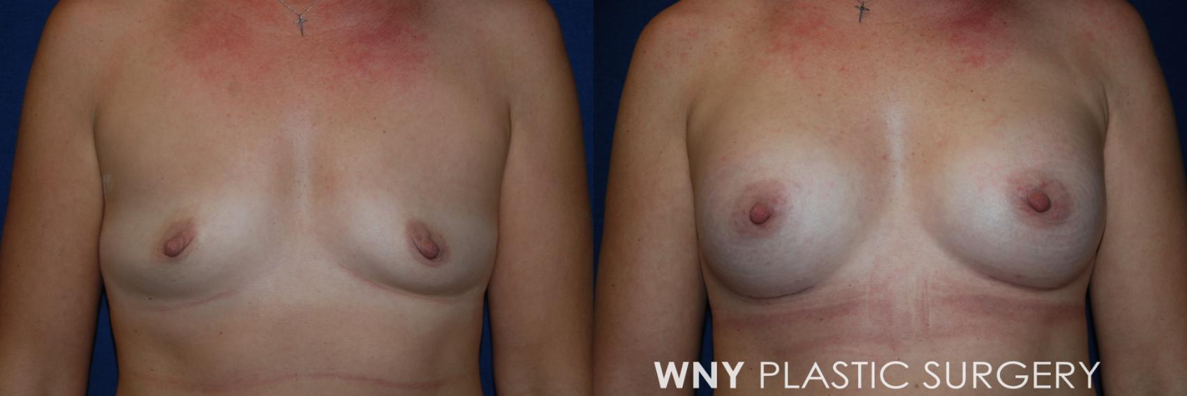 Before & After Breast Augmentation Case 220 Front View in Buffalo, NY
