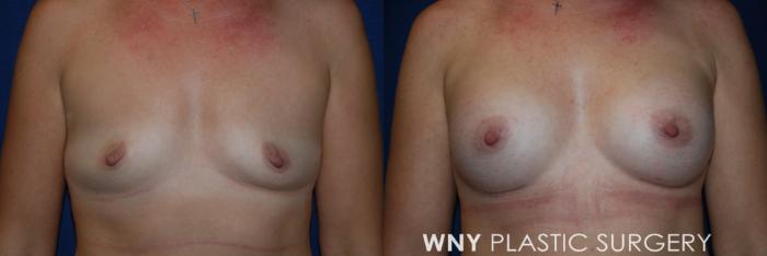Before & After Breast Augmentation Case 220 Front View in Williamsville, NY