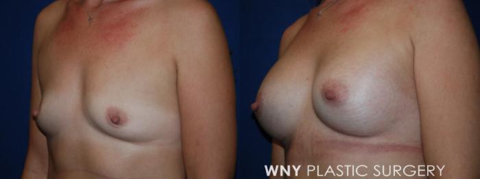 Before & After Breast Augmentation Case 220 Left Oblique View in Buffalo, NY