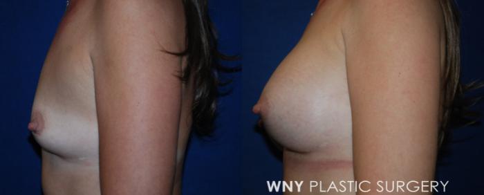 Before & After Breast Augmentation Case 220 Left Side View in Buffalo, NY