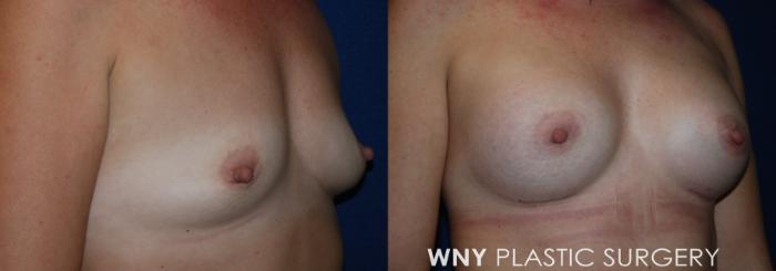 Before & After Breast Augmentation Case 220 Right Oblique View in Buffalo, NY