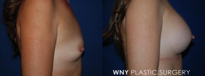 Before & After Breast Augmentation Case 220 Right Side View in Buffalo, NY