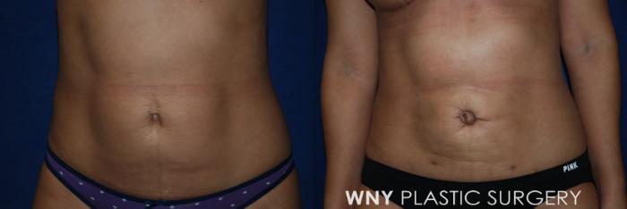 Before & After Breast Augmentation Case 222 Front Lower View in Williamsville, NY