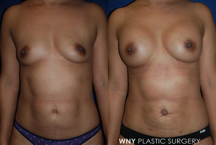 Before & After Breast Augmentation Case 222 Front View in Williamsville, NY