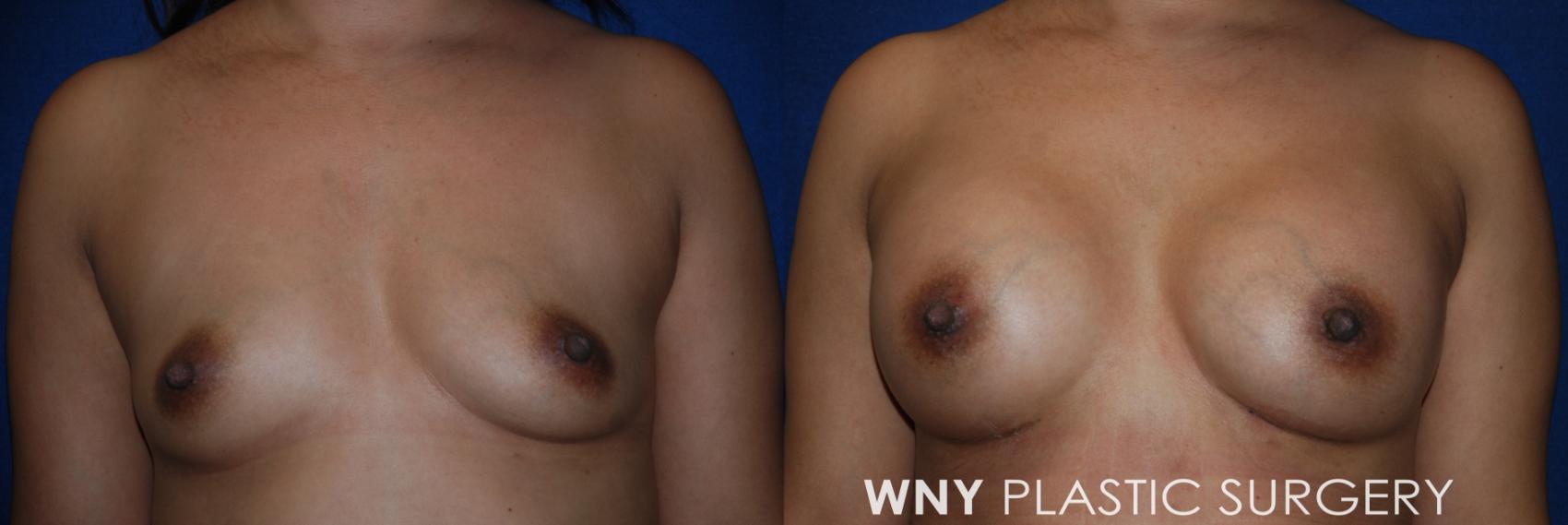 Before & After Breast Augmentation Case 222 Front Upper View in Williamsville, NY