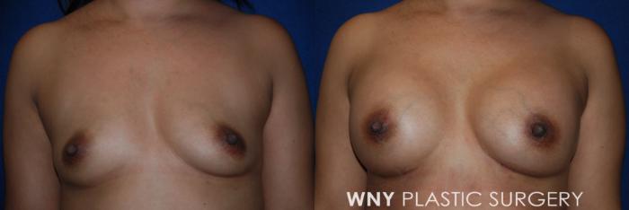 Before & After Liposuction Case 222 Front Upper View in Buffalo, NY