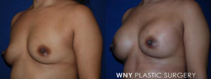Before & After Liposuction Case 222 Left Oblique Upper View in Williamsville, NY