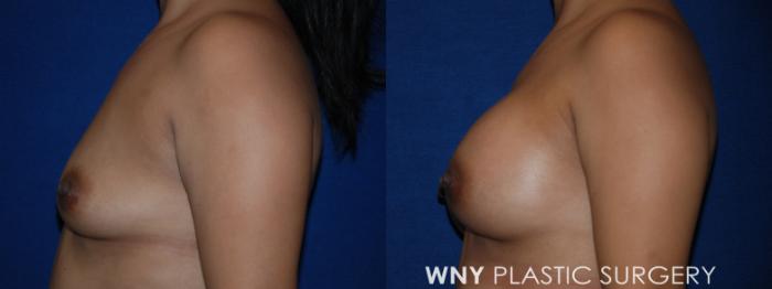 Before & After Liposuction Case 222 Left Side Upper View in Williamsville, NY