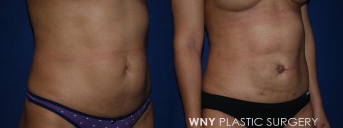 Before & After Breast Augmentation Case 222 Right Oblique Lower View in Williamsville, NY