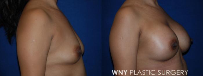 Before & After Breast Augmentation Case 222 Right Side Upper View in Williamsville, NY