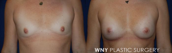 Before & After Breast Augmentation Case 225 Front View in Buffalo, NY