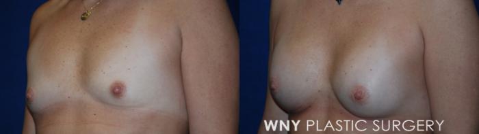 Before & After Breast Augmentation Case 225 Left Oblique View in Buffalo, NY