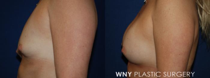 Before & After Breast Augmentation Case 225 Left Side View in Buffalo, NY