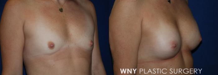 Before & After Breast Augmentation Case 225 Right Oblique View in Buffalo, NY