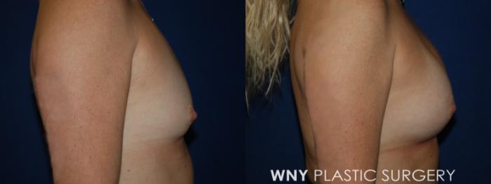 Before & After Breast Augmentation Case 225 Right Side View in Buffalo, NY