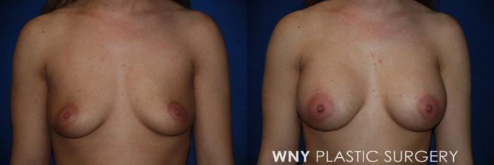 Before & After Breast Augmentation Case 226 Front View in Buffalo, NY