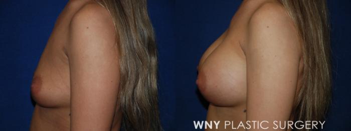 Before & After Breast Augmentation Case 226 Left Side View in Buffalo, NY