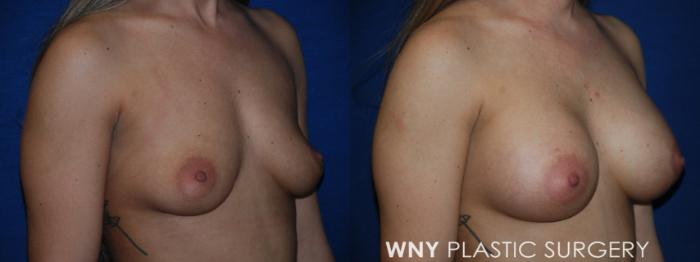 Before & After Breast Augmentation Case 226 Right Oblique View in Buffalo, NY