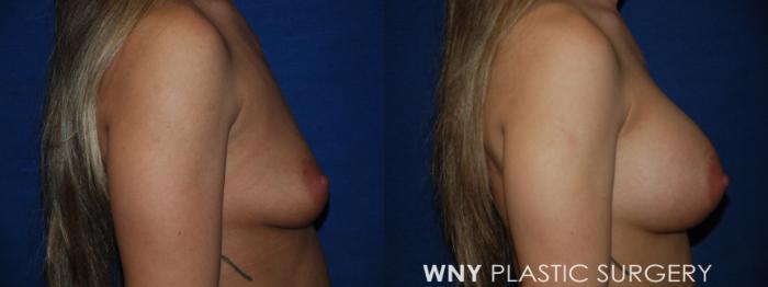 Before & After Breast Augmentation Case 226 Right Side View in Buffalo, NY