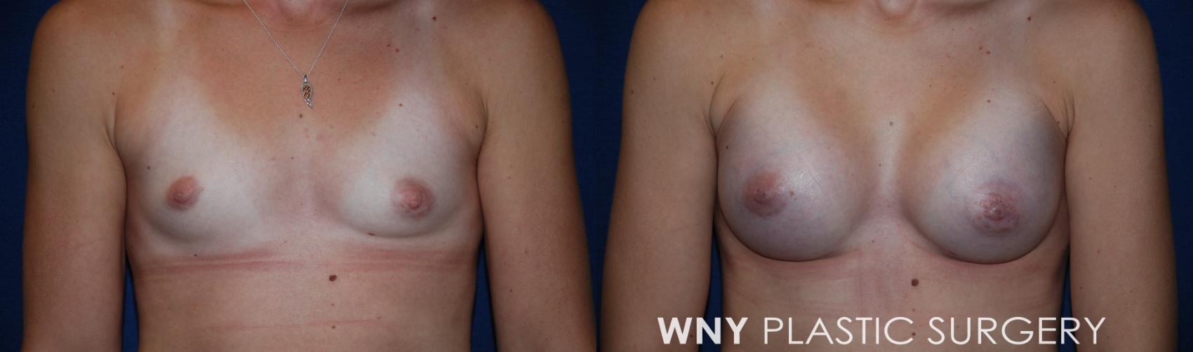 Before & After Breast Augmentation Case 228 Front View in Buffalo, NY