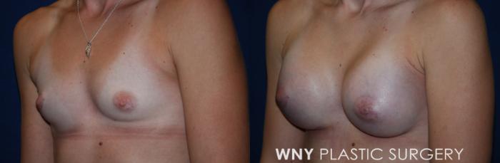Before & After Breast Augmentation Case 228 Left Oblique View in Buffalo, NY
