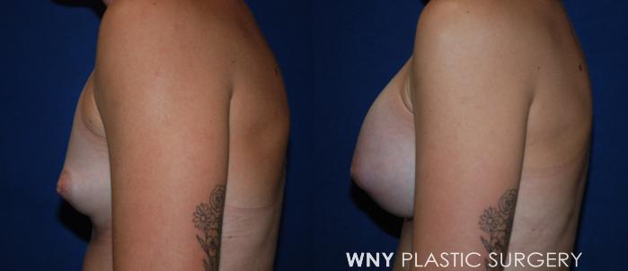 Before & After Breast Augmentation Case 228 Left Side View in Buffalo, NY