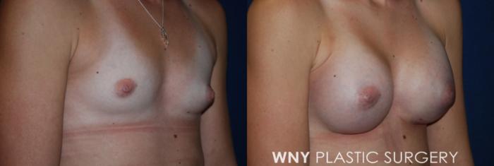 Before & After Breast Augmentation Case 228 Right Oblique View in Buffalo, NY
