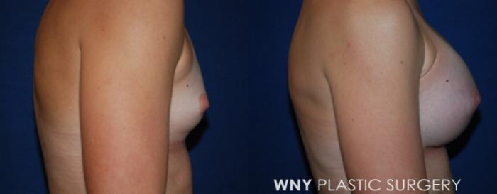 Before & After Breast Augmentation Case 228 Right Side View in Buffalo, NY