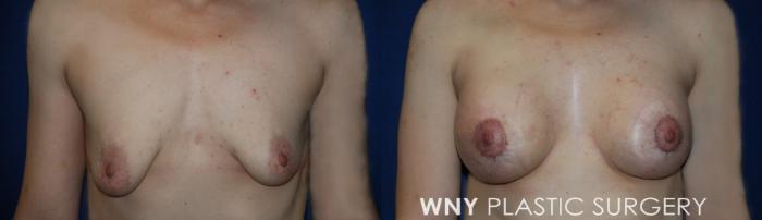 Before & After Breast Lift Case 229 Front View in Buffalo, NY