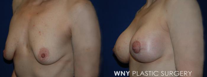 Before & After Breast Lift Case 229 Left Oblique View in Buffalo, NY