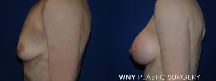 Before & After Breast Augmentation Case 229 Left Side View in Buffalo, NY