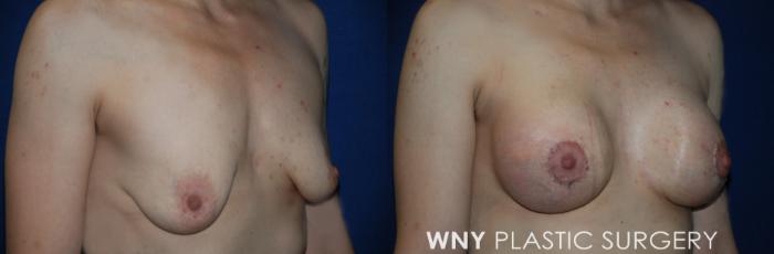 Before & After Breast Augmentation Case 229 Right Oblique View in Buffalo, NY