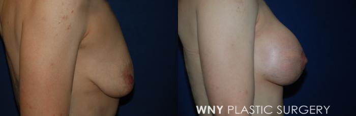 Before & After Breast Augmentation Case 229 Right Side View in Buffalo, NY