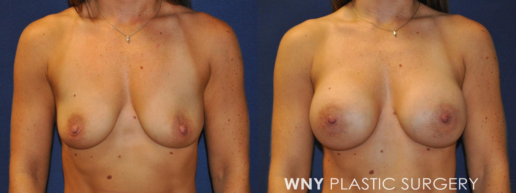 Before & After Breast Augmentation Case 231 Front View in Buffalo, NY