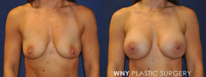 Before & After Breast Augmentation Case 231 Front View in Buffalo, NY