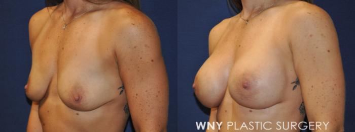 Before & After Breast Augmentation Case 231 Left Oblique View in Buffalo, NY