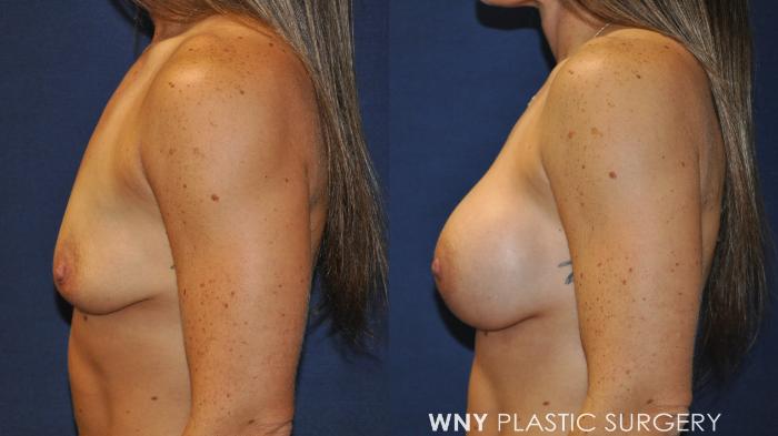 Before & After Breast Augmentation Case 231 Left Side View in Buffalo, NY