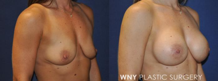 Before & After Breast Augmentation Case 231 Right Oblique View in Buffalo, NY